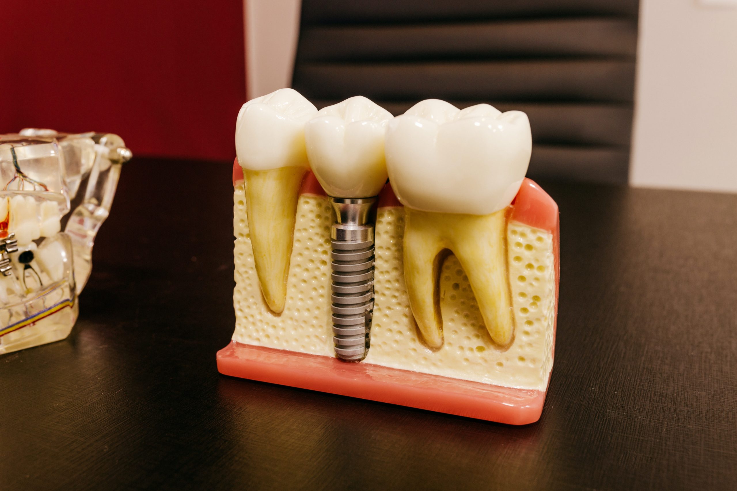 dental implant Mooresville NC