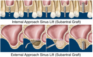 sinus lift procedure Mooresville NC