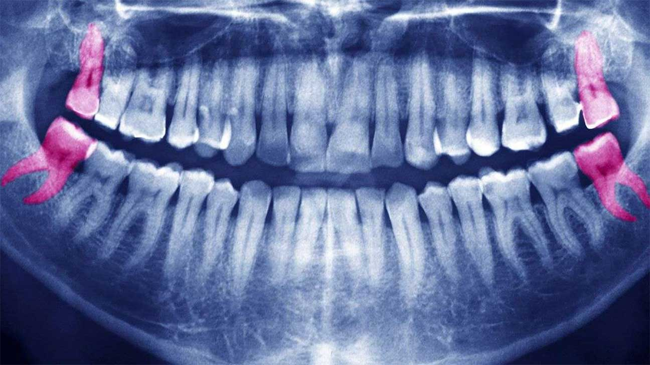 wisdom teeth extractions in Mooresville NC