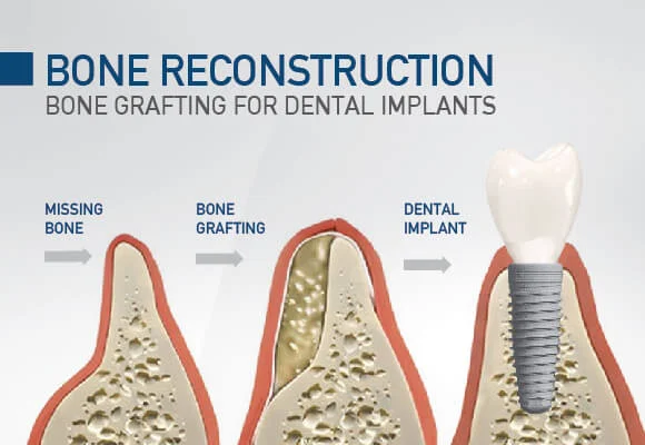 bone reconstruction for dental implants Mooresville NC