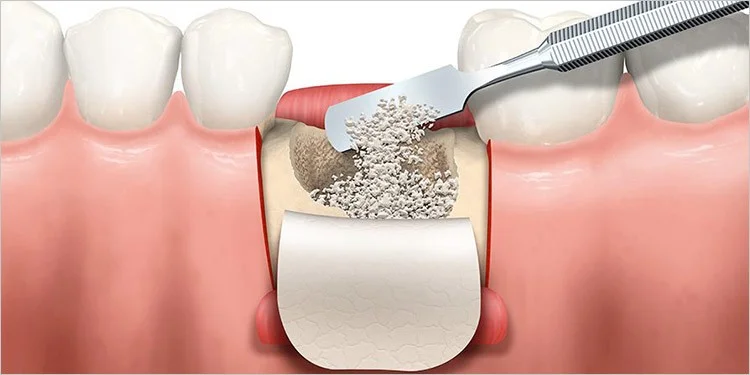 bone graft Mooresville NC